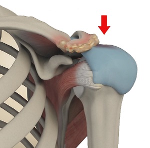 Subacromial Impingement Syndrome Long Island NY Physical Therapy Suffolk County NY