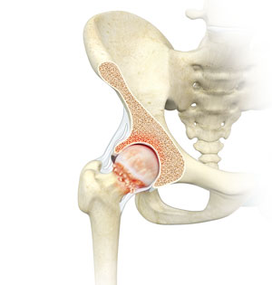 Hip Bones and socket (Gluteal Region).