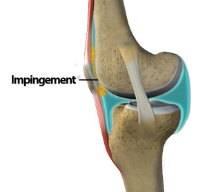 Patellar Tracking Disorder: What it is, Causes, and Treatment