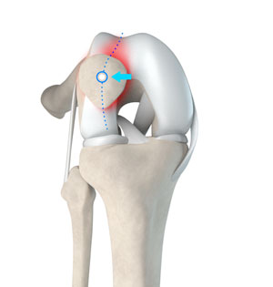 PATELLAR TRACKING DISORDER The patella (kneecap) is held in place by the  qua…  Patellar tracking disorder, Physical therapy exercises,  Patellofemoral pain syndrome